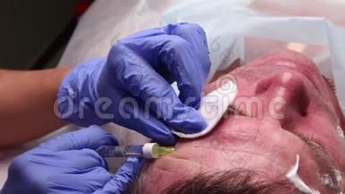 整形外科医生的手在病人`脸上画轮廓。 用于面部轮廓整形的手术。